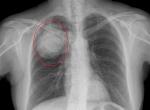 1 - Ausgedehnter Lungentumor des rechten oberen Lungenflügels (Befund 2010 - Männlich)